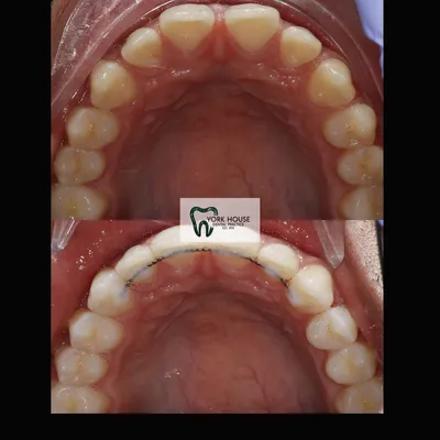 cosmetic dentistry West Byfleet - Case Smile Transformation 39 before and after result