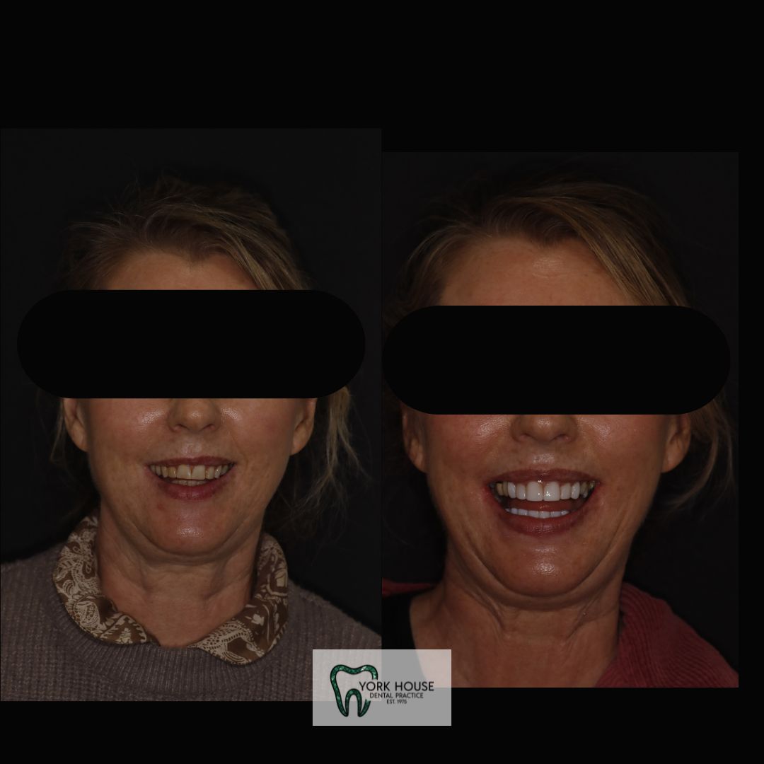 Smile Transformation 4 after treatment at York House Dental Practice