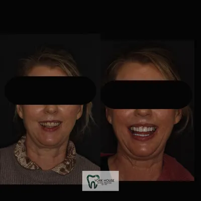 cosmetic dentistry West Byfleet - Case Smile Transformation 4 before and after result