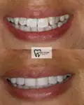 Before and after Invisalign Case 4 thumbnail result - dentist in West Byfleet