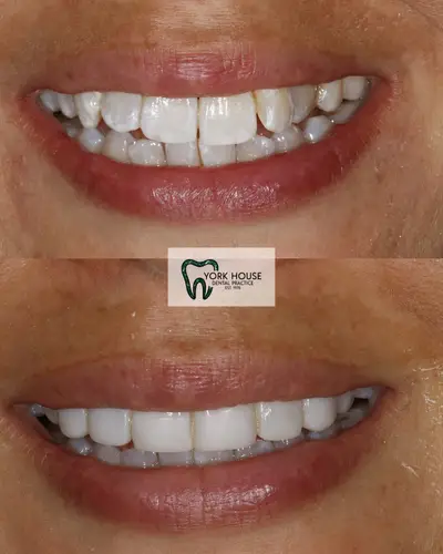 cosmetic dentistry West Byfleet - Case Invisalign Case 4 before and after result