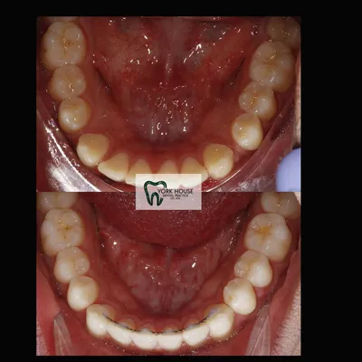 cosmetic dentistry West Byfleet - Case Smile Transformation 40 before and after result