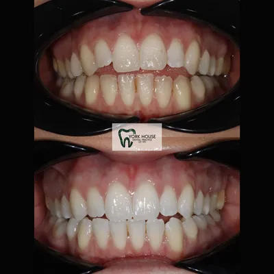 cosmetic dentistry West Byfleet - Case Smile Transformation 41 before and after result