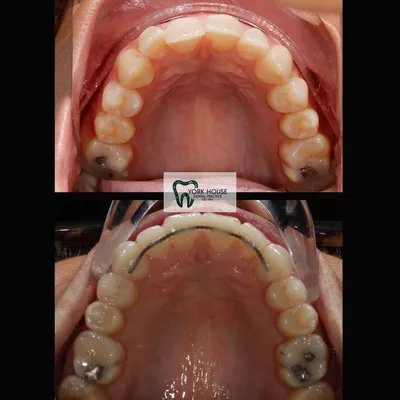cosmetic dentistry West Byfleet - Case Smile Transformation 42 before and after result