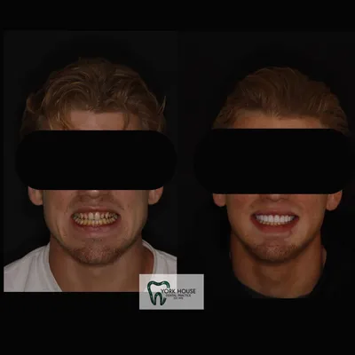 cosmetic dentistry West Byfleet - Case Smile Transformation 43 before and after result