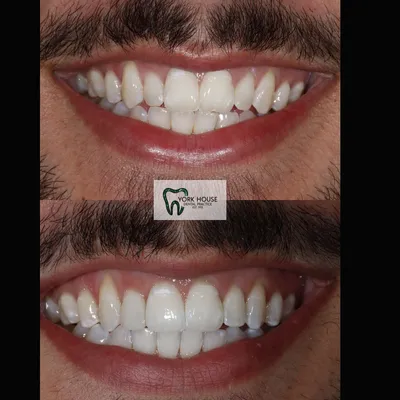 cosmetic dentistry West Byfleet - Case Smile Transformation 44 before and after result