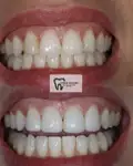 Before and after Invisalign Case 5 thumbnail result - dentist in West Byfleet