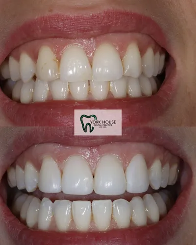 cosmetic dentistry West Byfleet - Case Invisalign Case 5 before and after result