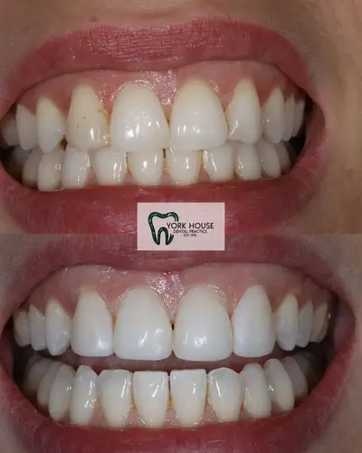 cosmetic dentistry West Byfleet - Case Invisalign Case 5 before and after result