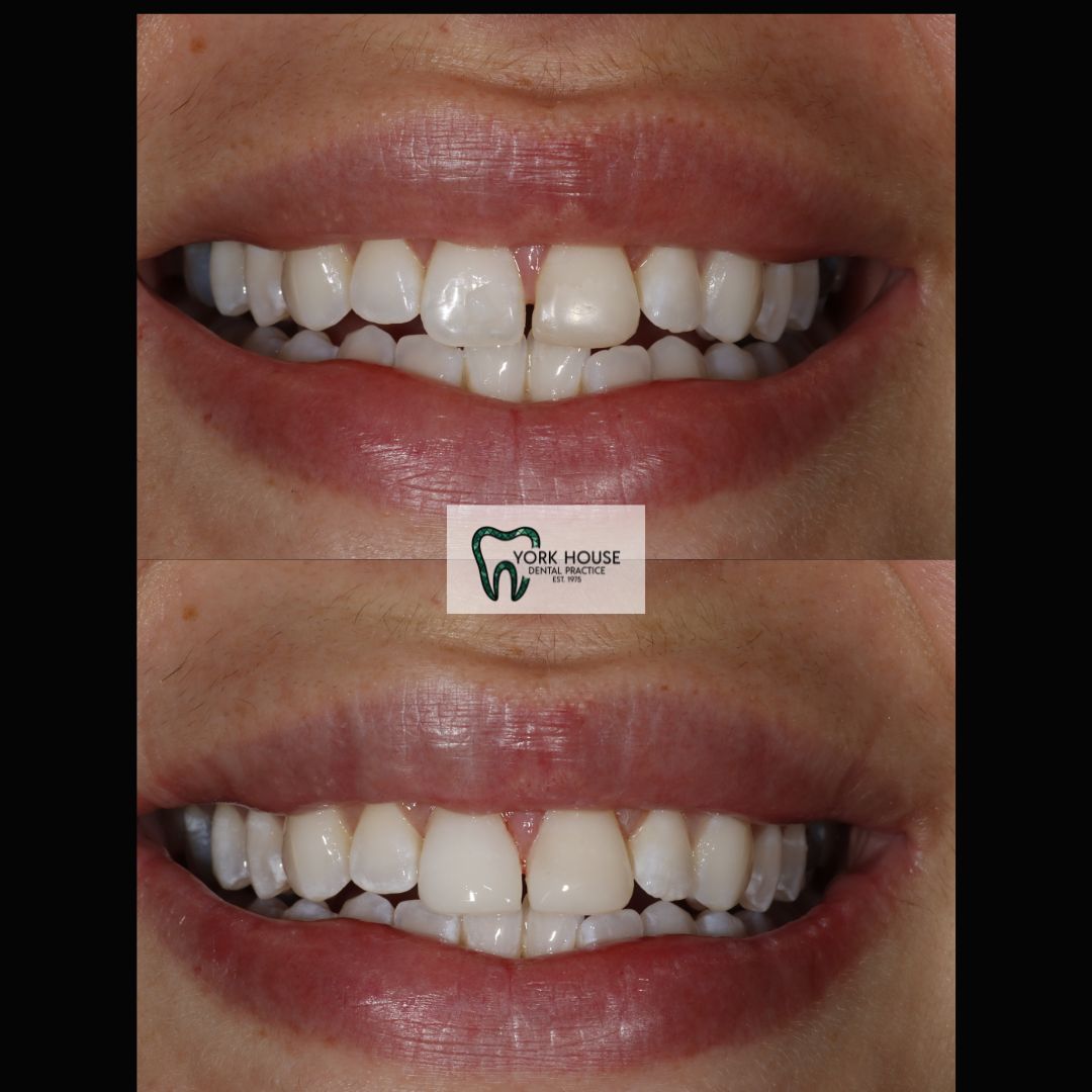 Smile Transformation 5 after treatment at York House Dental Practice