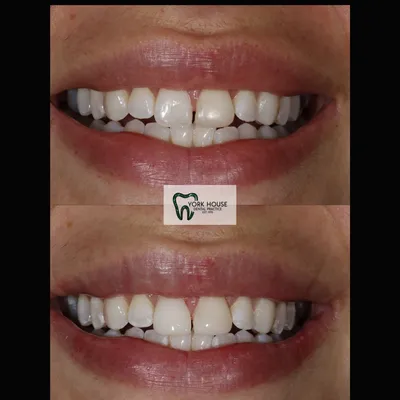 cosmetic dentistry West Byfleet - Case Smile Transformation 5 before and after result