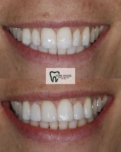 cosmetic dentistry West Byfleet - Case Invisalign Case 6 before and after result