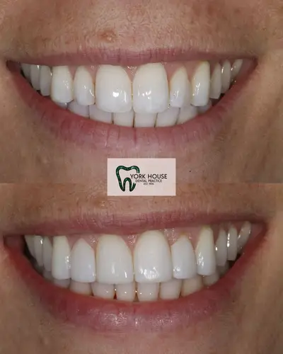 cosmetic dentistry West Byfleet - Case Invisalign Case 6 before and after result