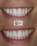Before and after Invisalign Case 6 thumbnail result - dentist in West Byfleet