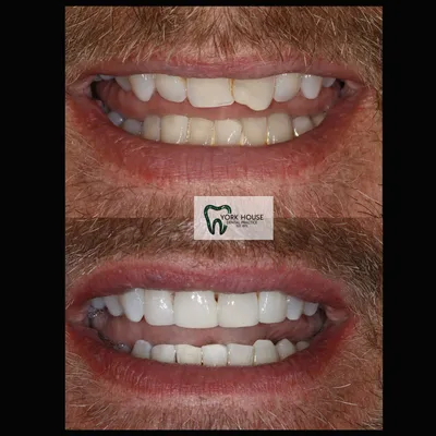 cosmetic dentistry West Byfleet - Case Smile Transformation 7 before and after result