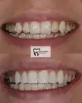 Before and after Invisalign Case 7 thumbnail result - dentist in West Byfleet