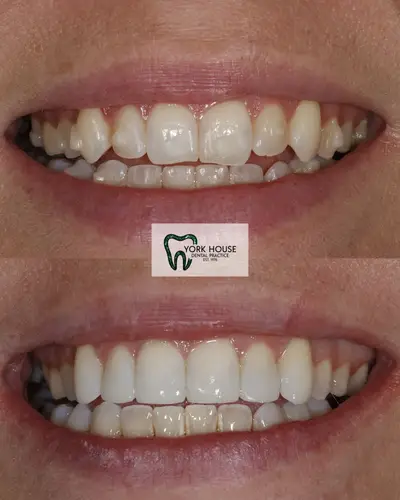 cosmetic dentistry West Byfleet - Case Invisalign Case 7 before and after result