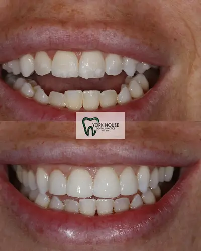 cosmetic dentistry West Byfleet - Case Invisalign Case 8 before and after result