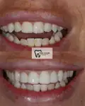 Before and after Invisalign Case 8 thumbnail result - dentist in West Byfleet