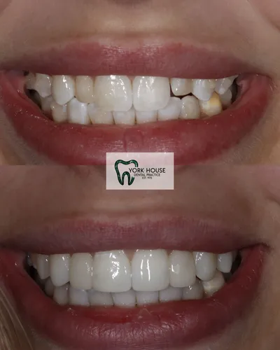 Invisible Aligners vs Fixed Braces: A Clinician’s Evidence-Based Guide to Long-Term Orthodontic Outcomes for Adults and Teenagers