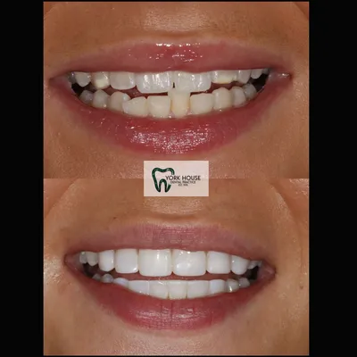 cosmetic dentistry West Byfleet - Case Cosmetic Case AB-1 before and after result