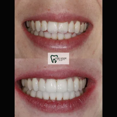 cosmetic dentistry West Byfleet - Case Cosmetic Case AB-2 before and after result