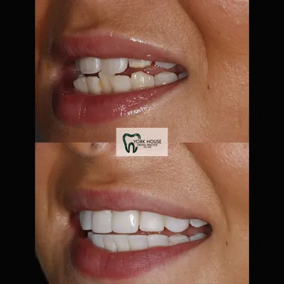 cosmetic dentistry West Byfleet - Case Cosmetic Case AB-3 before and after result