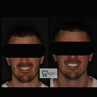 cosmetic dentistry West Byfleet - Case Cosmetic Case AJ-1 before and after result