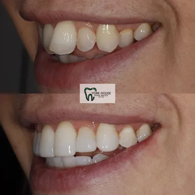 cosmetic dentistry West Byfleet - Case Cosmetic Case AJ-2 before and after result