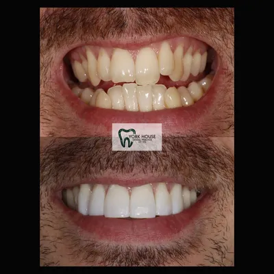 cosmetic dentistry West Byfleet - Case Cosmetic Case AJ-3 before and after result