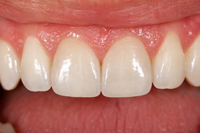 Close-up of natural-looking composite bonding on front teeth