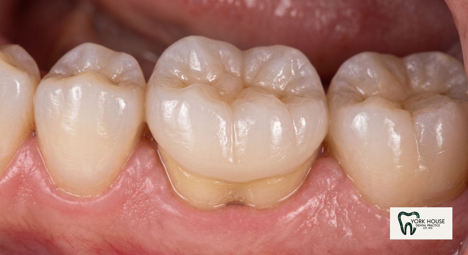 All-Ceramic Crown