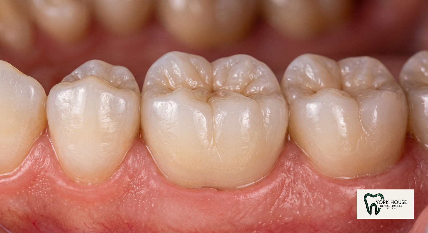 Zirconia Crown