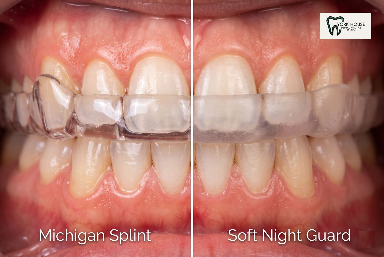 Hard acrylic Michigan splint vs soft night guard custom-crafted at York House Dental Practice in West Byfleet, Surrey