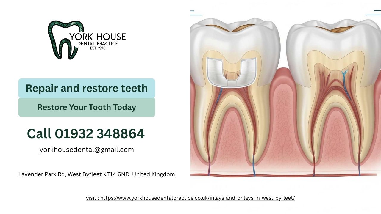 Inlays and Onlays York House Dental Practice 2025 December