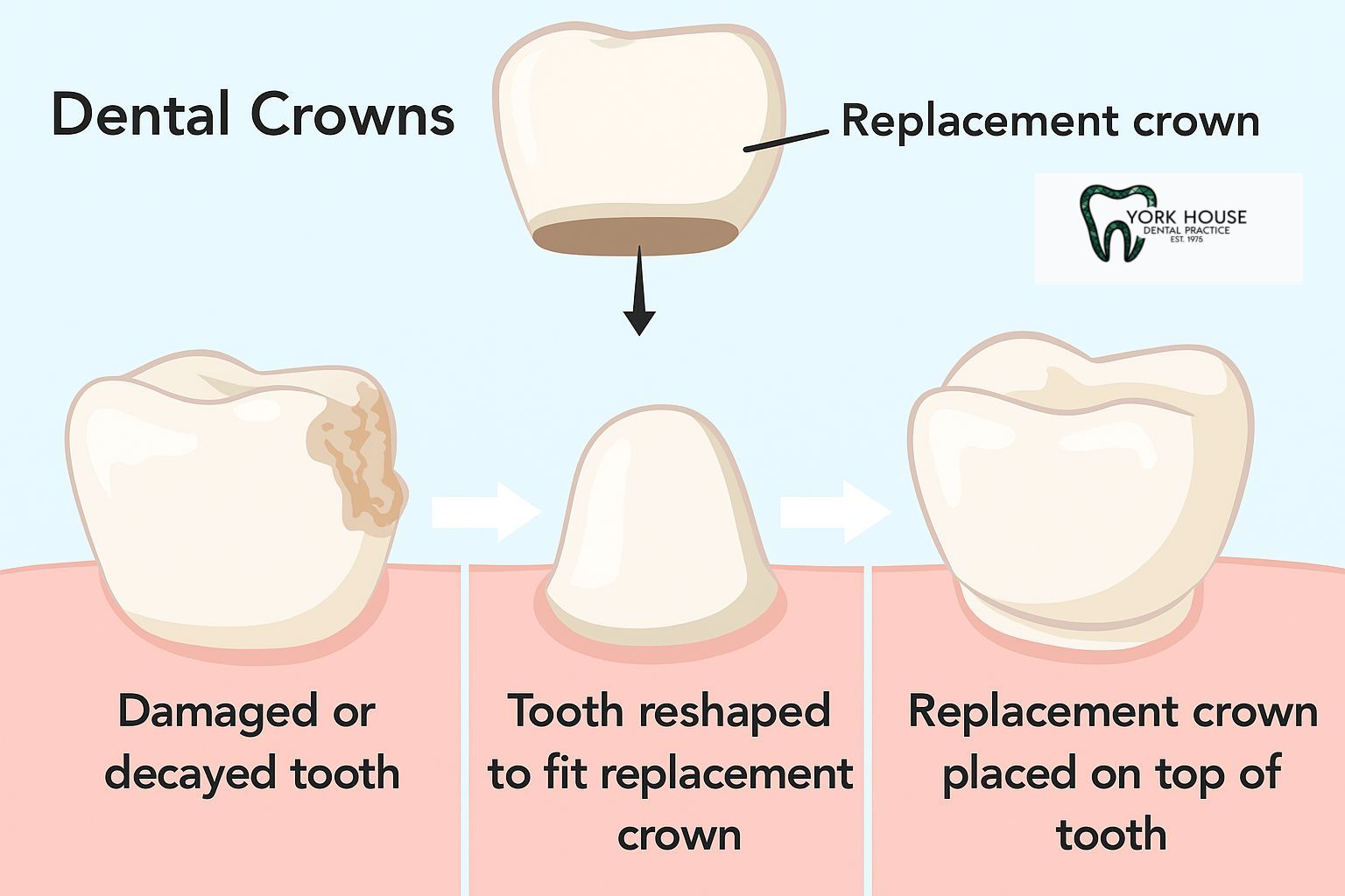crown placement 1 York House Dental Practice 2025 December