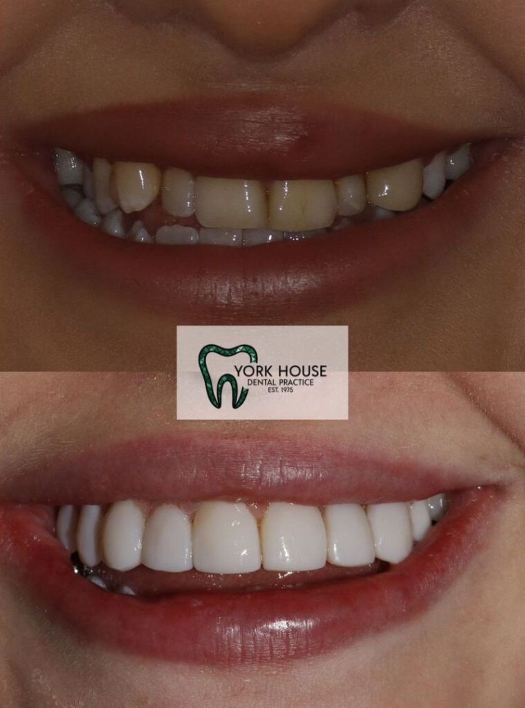 invisalign in west byfleet surrey