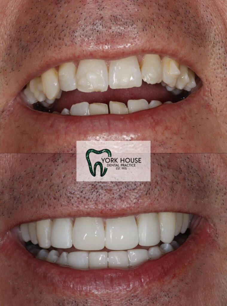 invisalign in west byfleet surrey