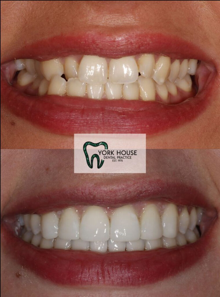 invisalign in west byfleet surrey