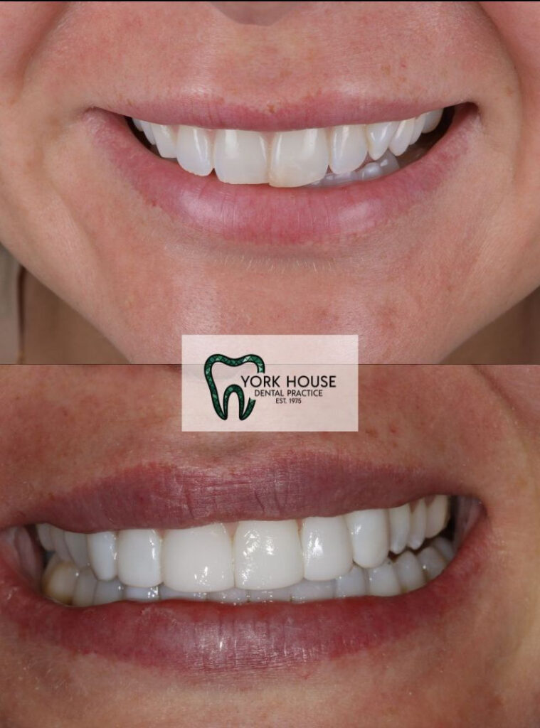 invisalign in west byfleet surrey