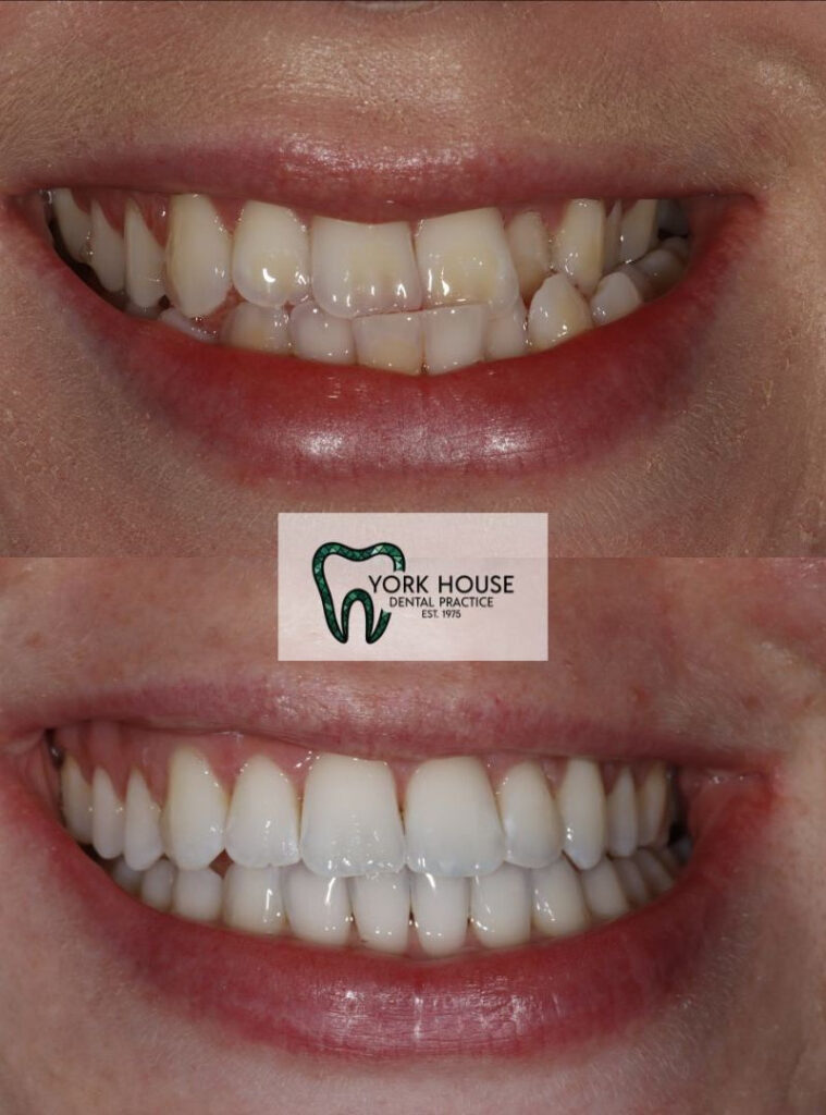invisalign in west byfleet surrey