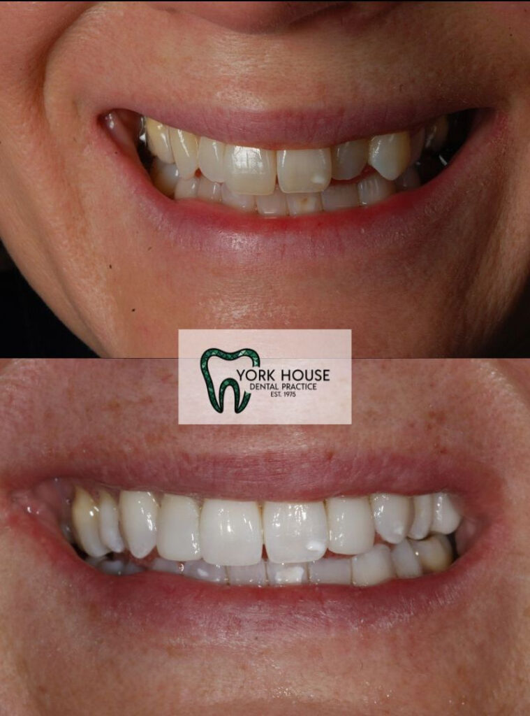 invisalign in west byfleet surrey