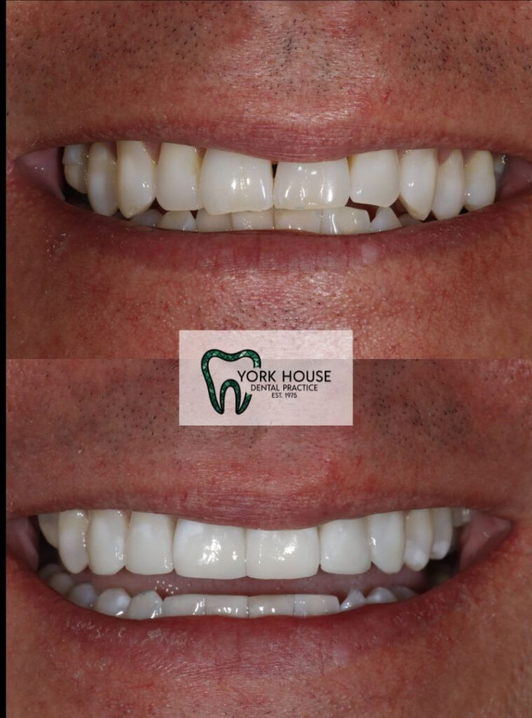 invisalign in west byfleet surrey