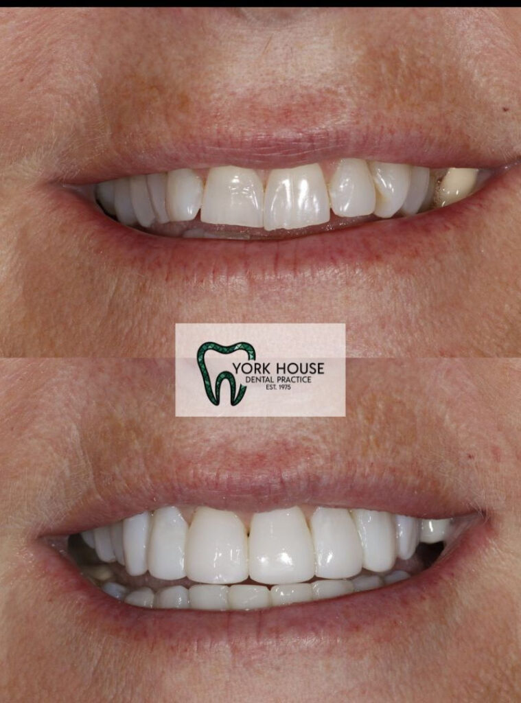 invisalign in west byfleet surrey