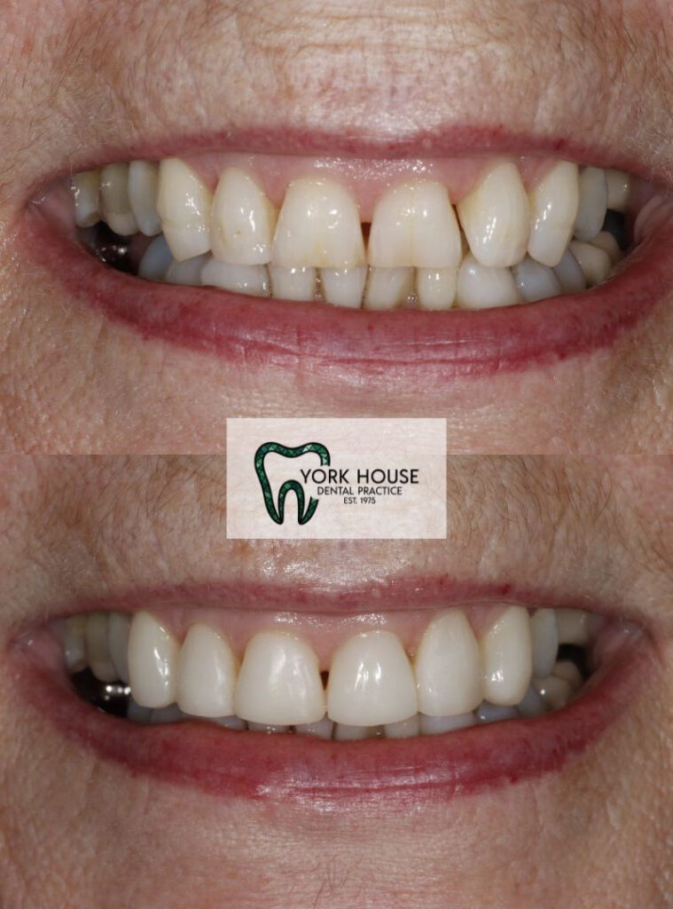 invisalign in west byfleet surrey