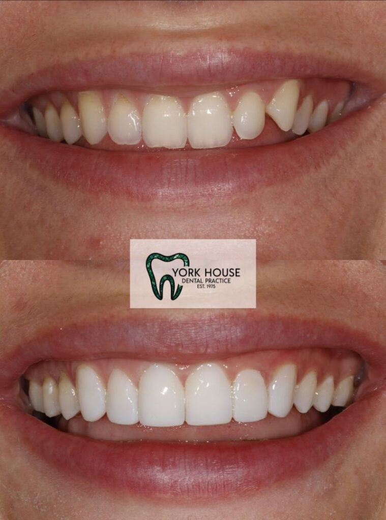 invisalign in west byfleet surrey