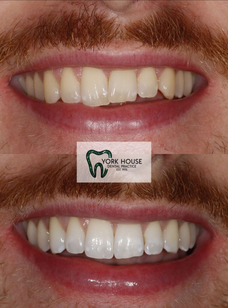 invisalign in west byfleet surrey